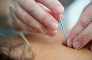 A close up of a person's hand inserting an acupuncture needle into another person, with two other needles already stuck into them